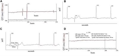 Arrhythmic Risk in Elderly Patients Candidates to Transcatheter Aortic Valve Replacement: Predictive Role of Repolarization Temporal Dispersion